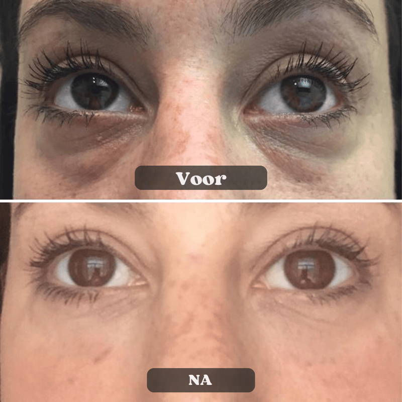 DermaFuse-patches - aanbevolen door dertmatologen